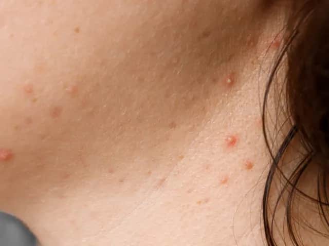 Pryszcze na szyi co oznaczają i jak uniknąć ich powstawania