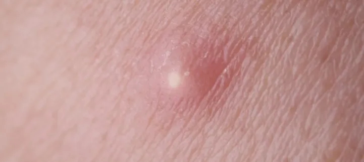 Skuteczne metody leczenia pryszcza na wardze sromowej i objawy