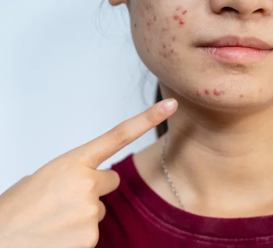 Pryszcze na brodzie od czego? Odkryj przyczyny i skuteczne rozwiązania