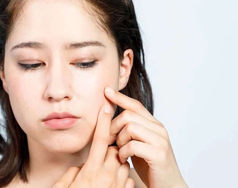 Czy pryszcz sam zniknie? Poznaj fakty o naturalnym gojeniu skóry