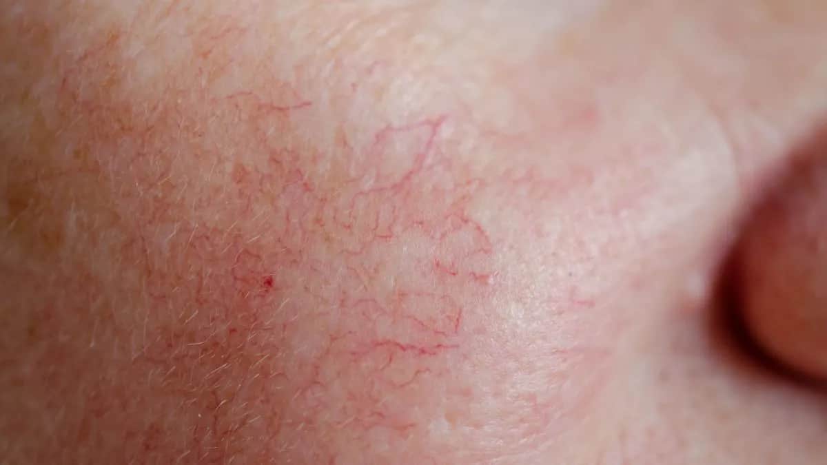 Jak wygląda cera naczynkowa? Poznaj jej objawy i pielęgnację