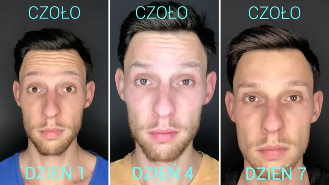 Botox efekty po jakim czasie – poznaj, kiedy zobaczysz rezultaty