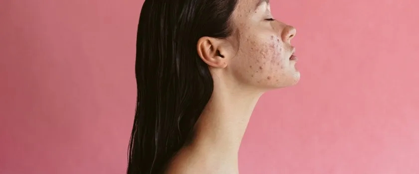 Co na wycisniete pryszcze? Skuteczne sposoby na szybką regenerację