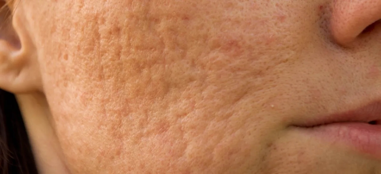 Jak szybko zagoić ranę po pryszczu i uniknąć blizn na skórze