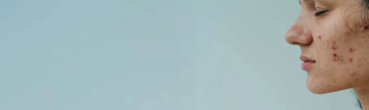 Pryszcze od czego? Poznaj przyczyny i skuteczne metody walki z trądzikiem