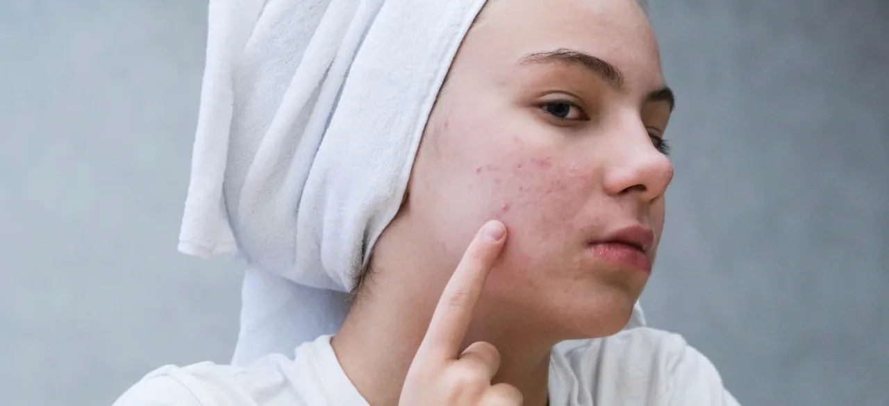 Skuteczne sposoby na pryszcz pod skórą, które przynoszą ulgę