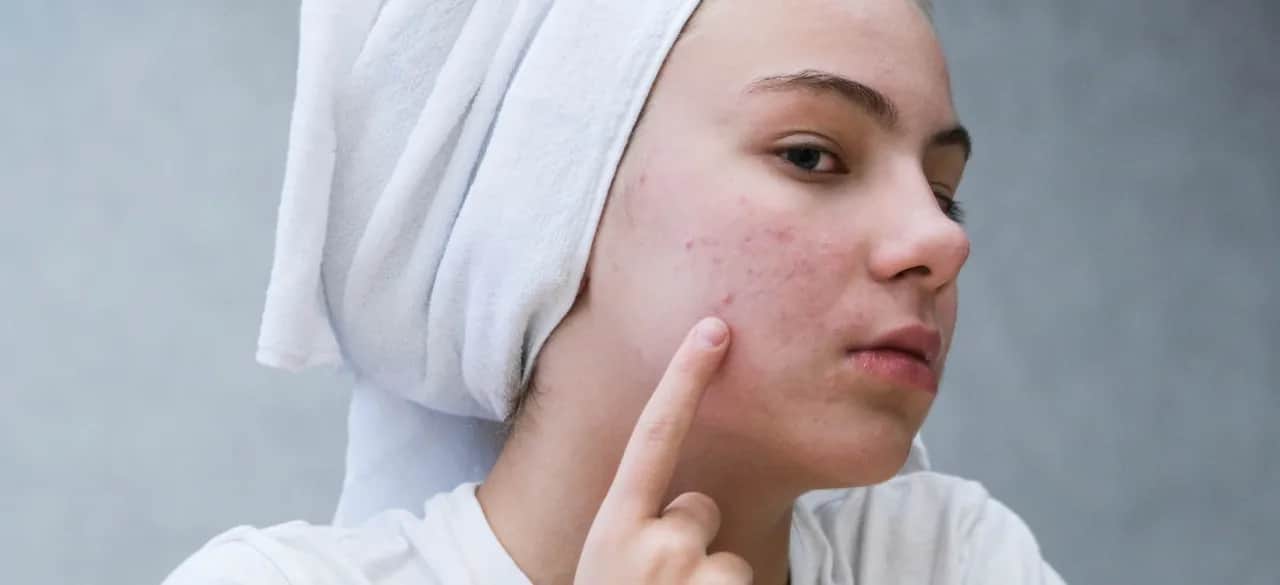 Skuteczne sposoby na pryszcz pod skórą, które przynoszą ulgę