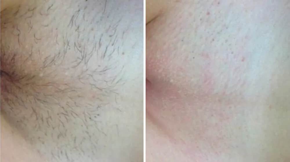 Bikini głębokie co to? Poznaj metody i efekty depilacji