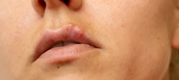 Opryszczka czy pryszcz: Kluczowe różnice i skuteczne leczenie
