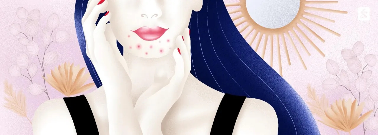 Od czego są pryszcze na brodzie i jak ich uniknąć w przyszłości