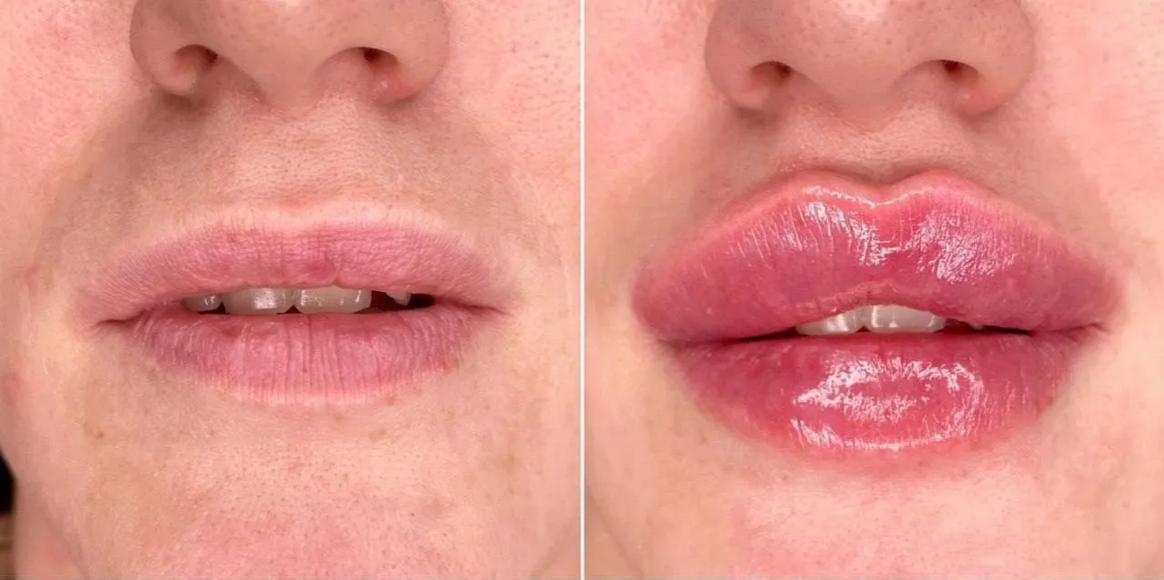 Czy po powiększaniu ust można palić? Skutki dla zdrowia i gojenia