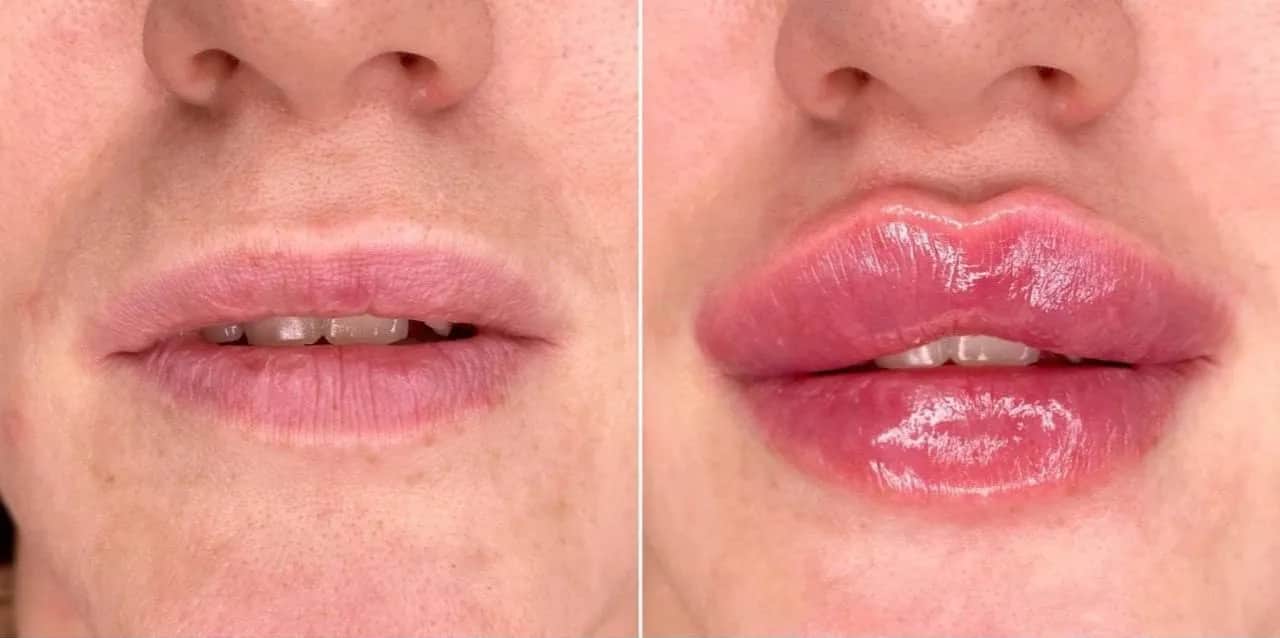 Czy po powiększaniu ust można palić? Skutki dla zdrowia i gojenia