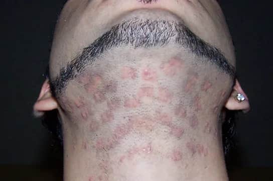 Czy można wyrywać włosy po depilacji laserowej? Skutki, które musisz znać