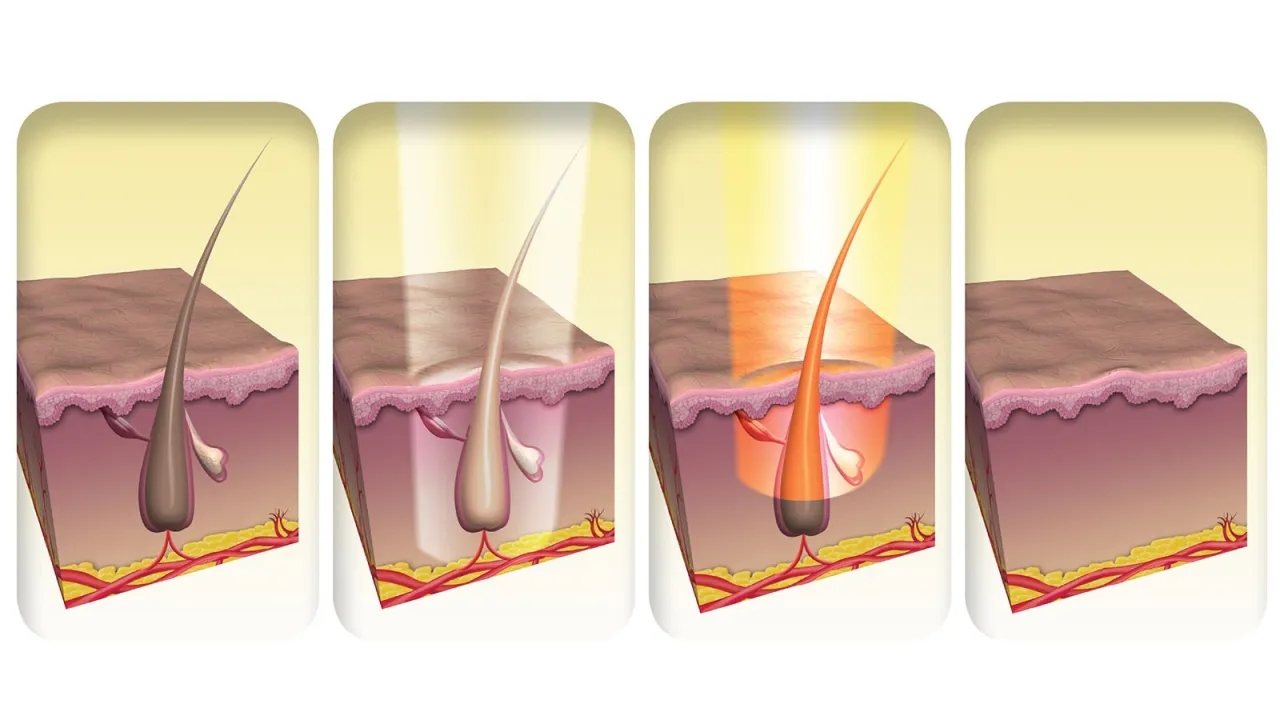 Jak działa depilator laserowy i dlaczego warto go wybrać?