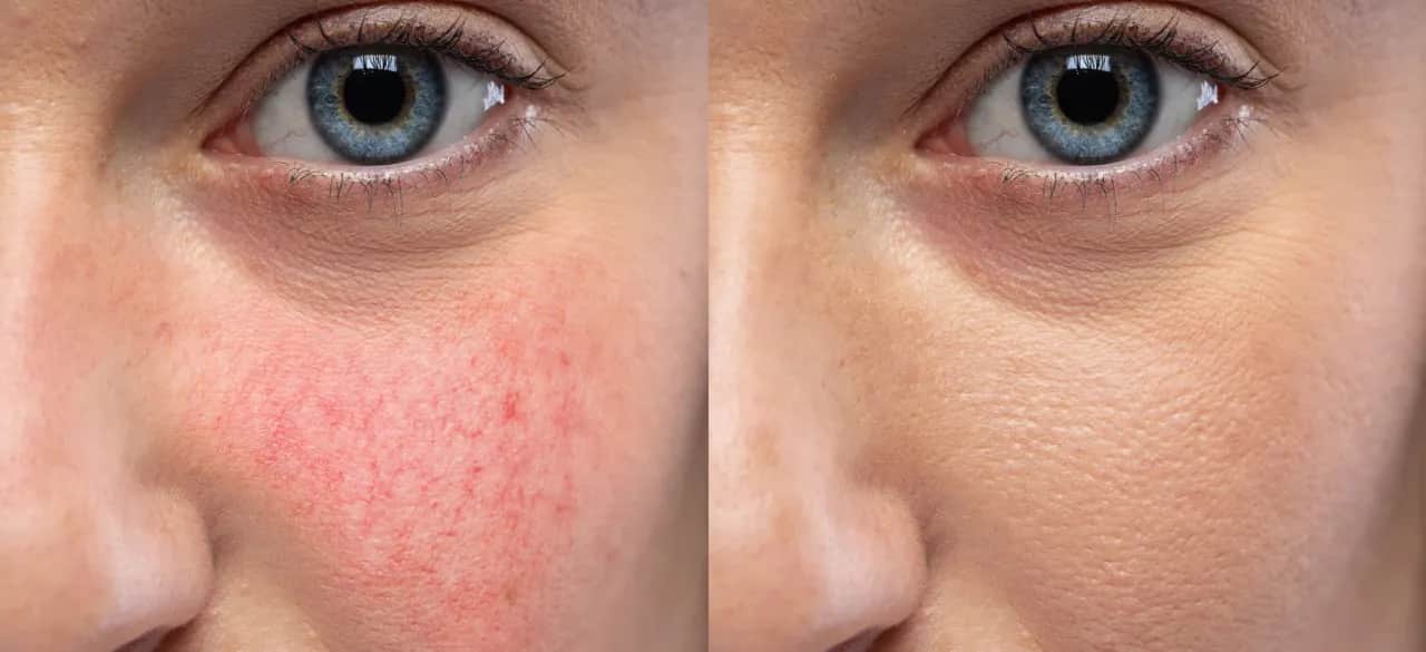 Cera naczynkowa objawy – jak rozpoznać i uniknąć problemów ze skórą