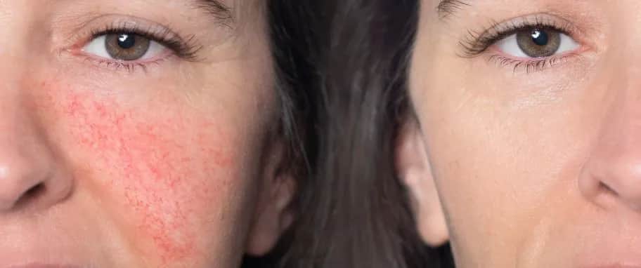 Jaki krem do cery naczynkowej? Odkryj skuteczne składniki i marki