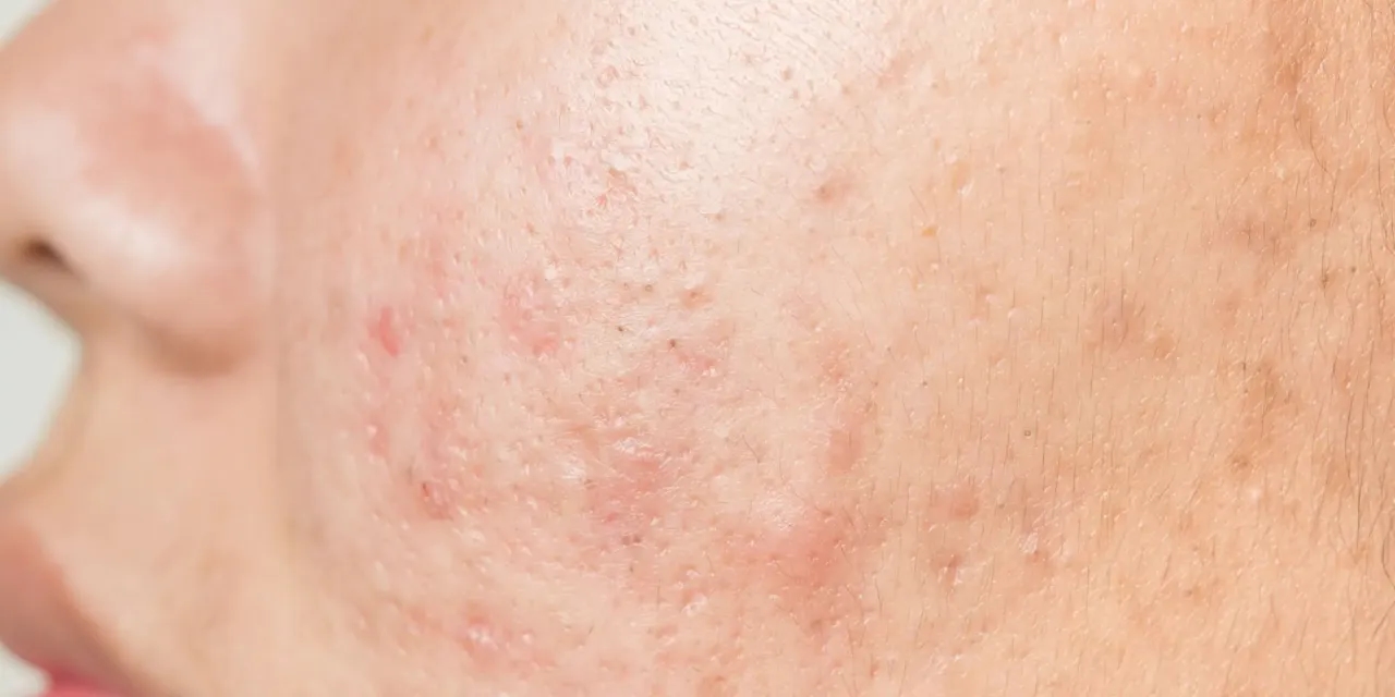 Dlaczego lubię oglądać wyciskanie pryszczy? Psychologia przyjemności i relaksu