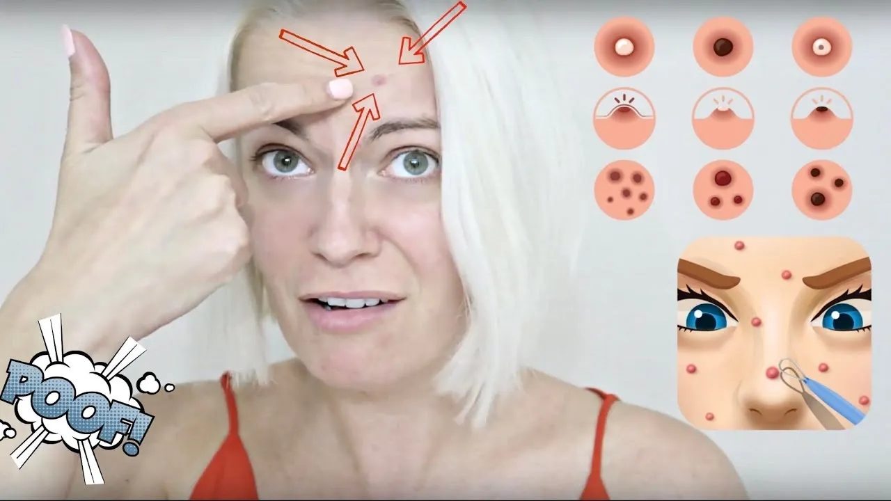 Jak wyleczyć pryszcza szybko i skutecznie – sprawdzone metody i porady