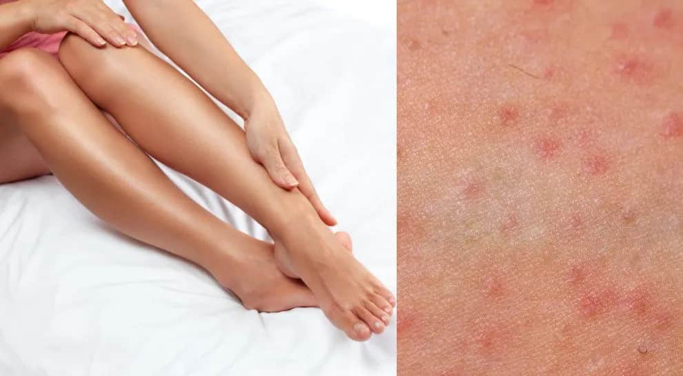 Jak pozbyć się krostek po goleniu - skuteczne metody i porady