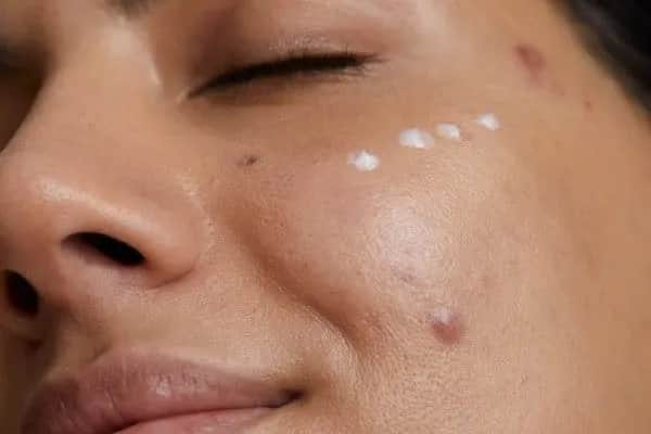 Jak pozbyć się pryszcza podskórnego - skuteczne domowe metody