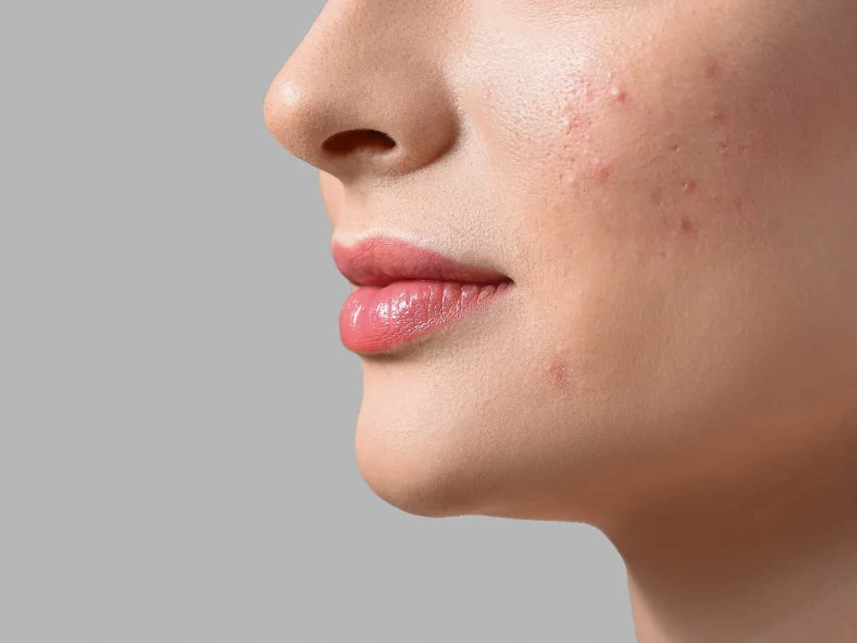 Jak pozbyć się bolącego podskórnego pryszcza i uniknąć bólu