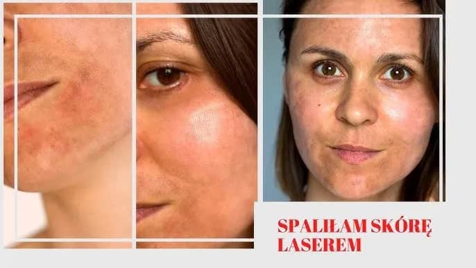 Jak długo goi się skóra po laserze frakcyjnym? Czas regeneracji