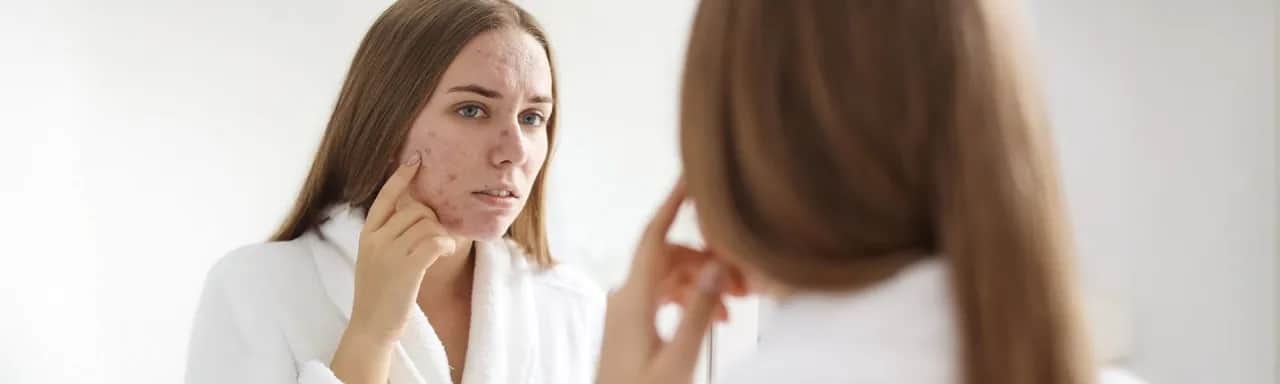 Jak dbać o cerę trądzikową, aby uniknąć blizn i podrażnień