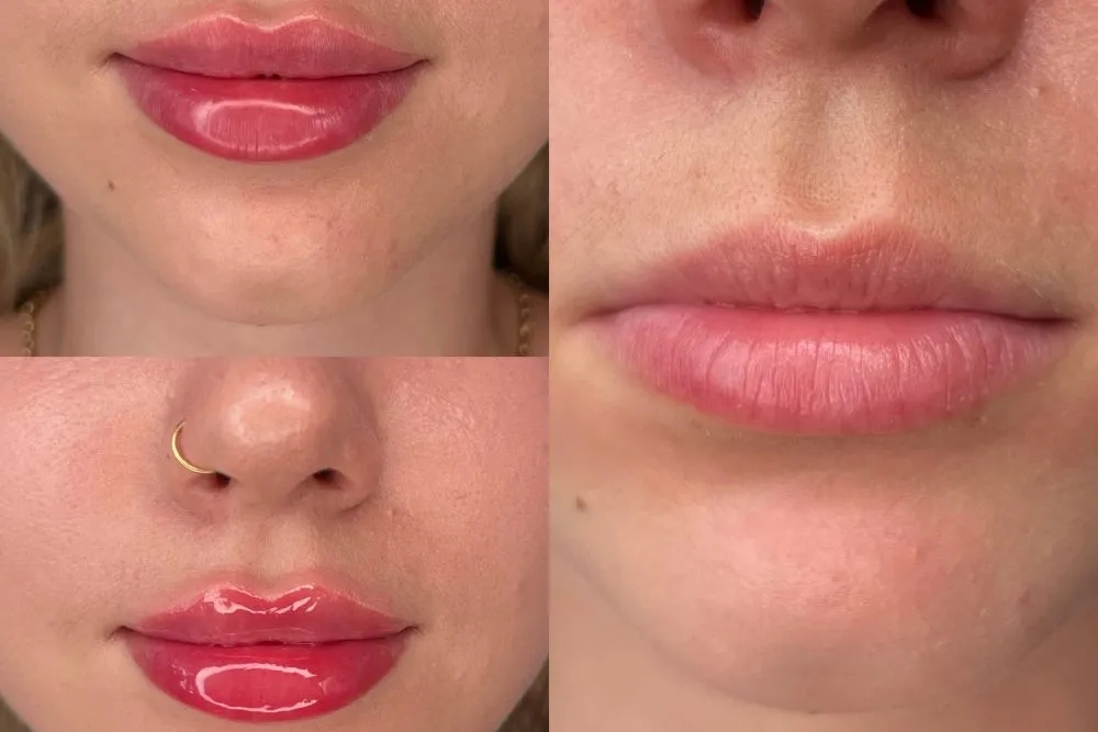 Czy po powiększaniu ust można jeść? Sprawdź, co warto unikać