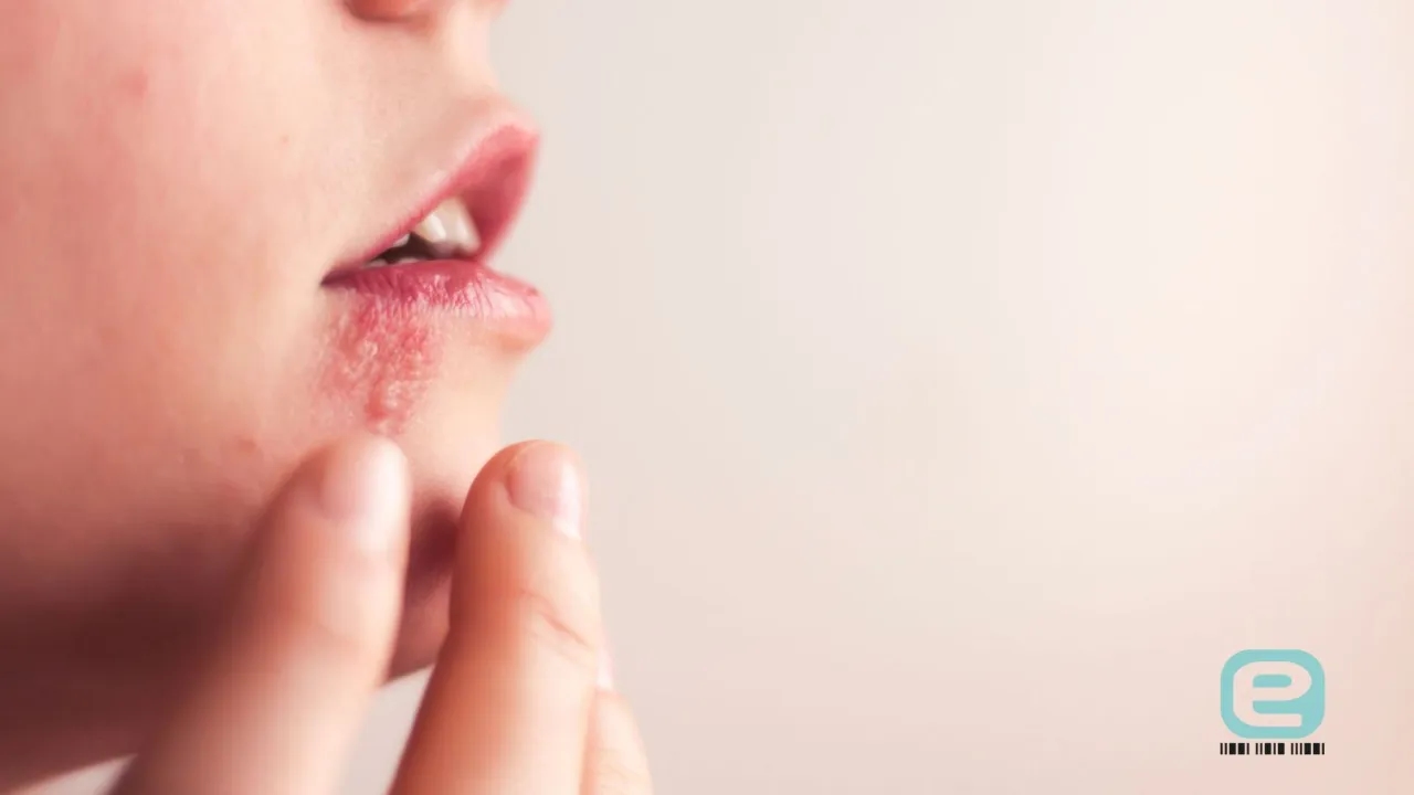 Skuteczne sposoby na pryszcz w nosie - jak się go pozbyć?