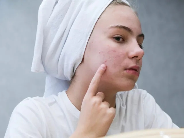 Ile dni przed okresem wyskakują pryszcze i jak ich uniknąć?