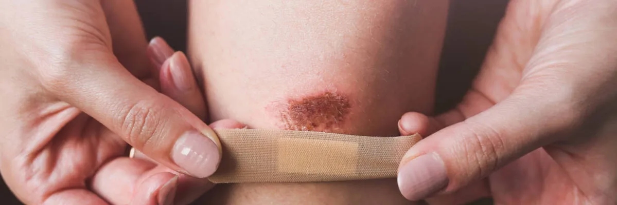 Co na rany po pryszczach? Skuteczne metody na szybkie gojenie