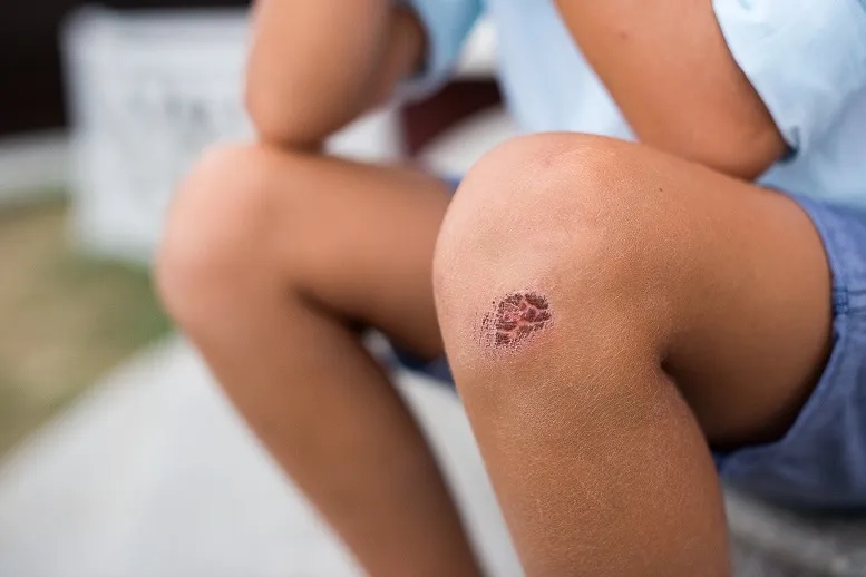 Ile goi się strup po pryszczu? Oto, co musisz wiedzieć, aby uniknąć blizn