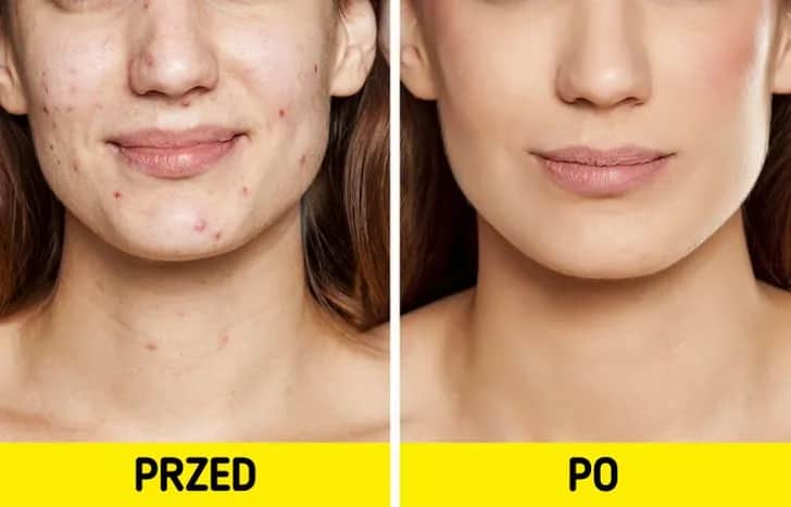 Skuteczne sposoby na pryszcze – jak się pozbyć niedoskonałości w 5 krokach