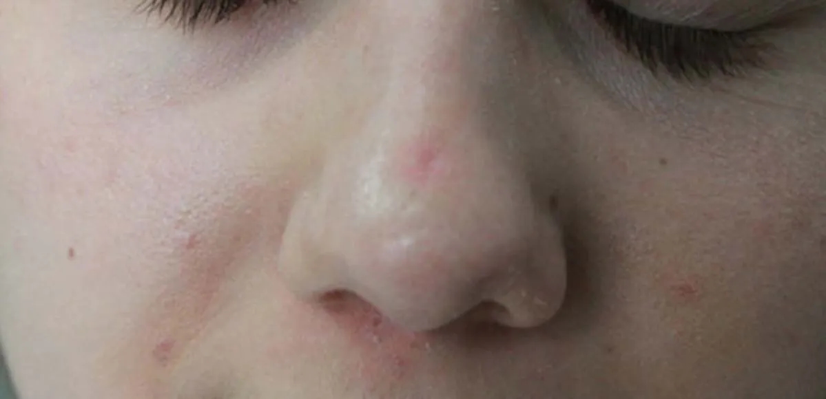 Jak przyspieszyć gojenie rany po pryszczu i uniknąć blizn