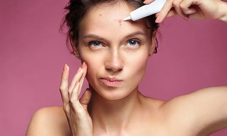 Jak usuwać pryszcze skutecznie – domowe metody i profesjonalne porady