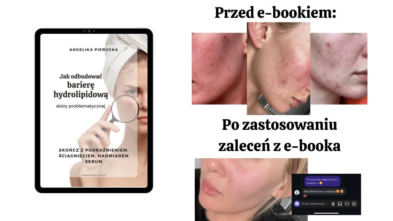 Skuteczne sposoby na czerwone plamy po pryszczach, które działają