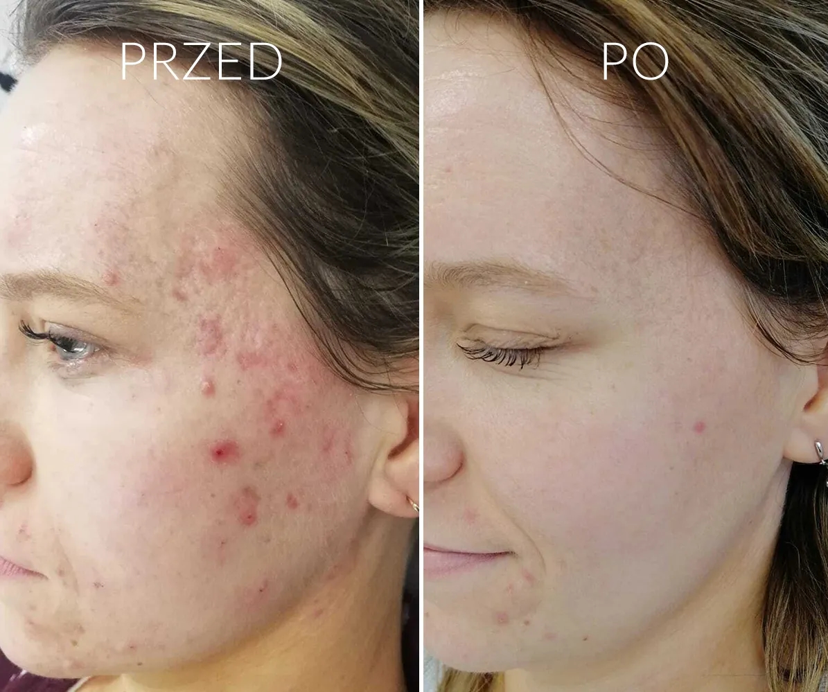 Skuteczne domowe sposoby na pryszcze na twarzy, które działają