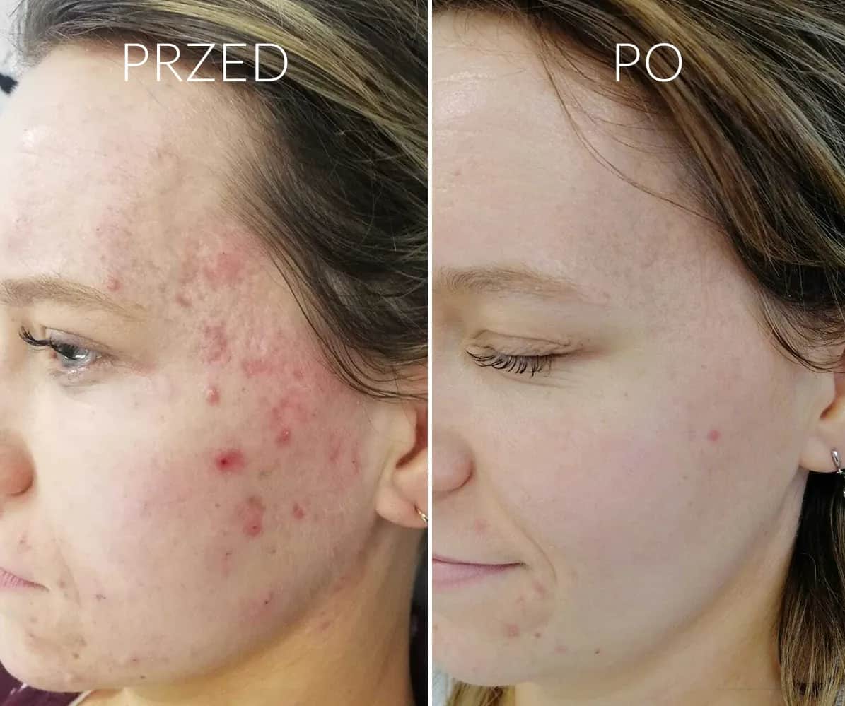 Skuteczne domowe sposoby na pryszcze na twarzy, które działają