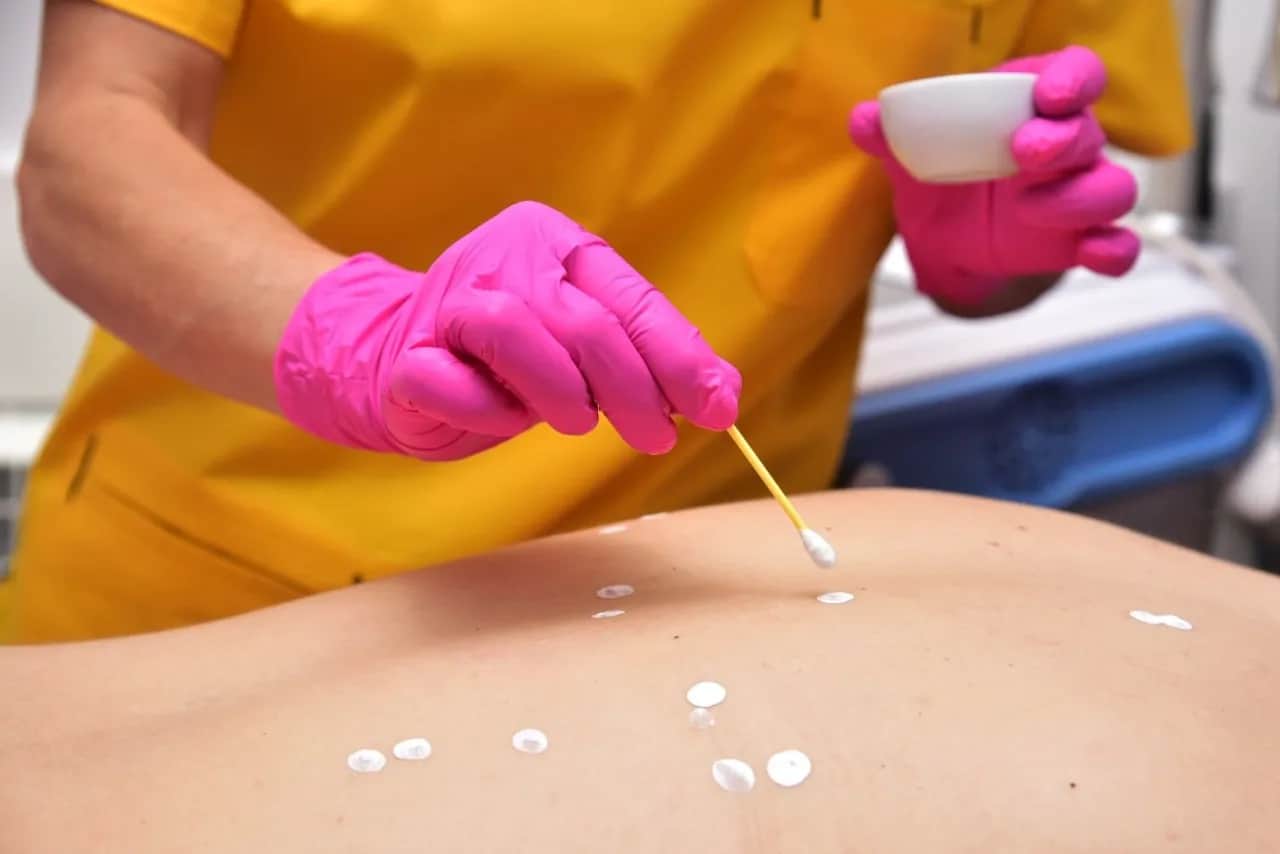 Czy maść cynkowa naprawdę pomaga na pryszcze? Odkryj skutki i zalety