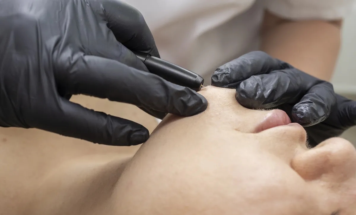 Elektroepilacja co to – skuteczna metoda trwałego usuwania włosów