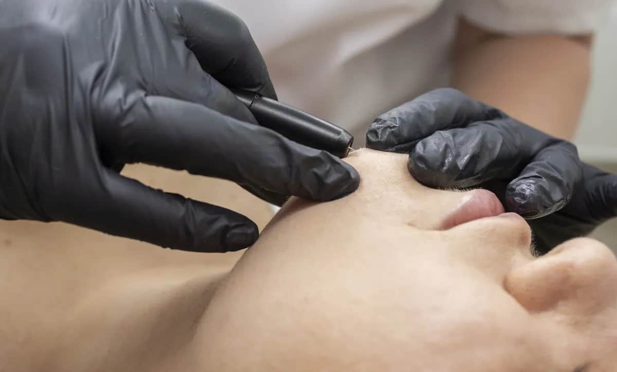 Elektroepilacja co to – skuteczna metoda trwałego usuwania włosów