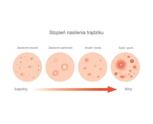 Pryszcze na czole od czego? Odkryj przyczyny i skuteczne rozwiązania