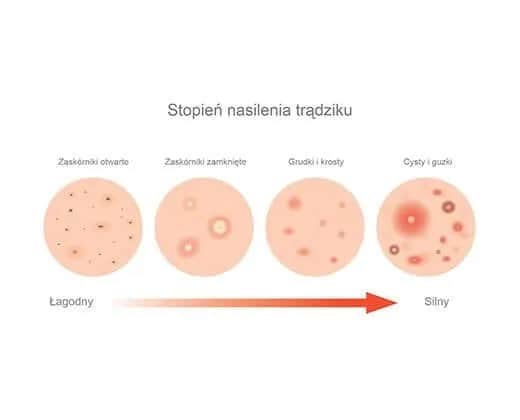 Pryszcze na czole od czego? Odkryj przyczyny i skuteczne rozwiązania