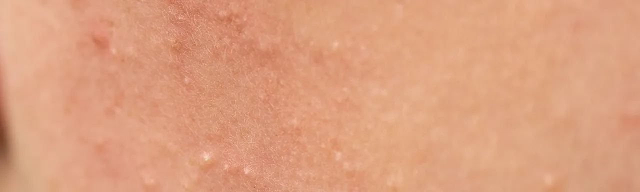 Jak wygląda zapchana cera i jak ją skutecznie wyleczyć?