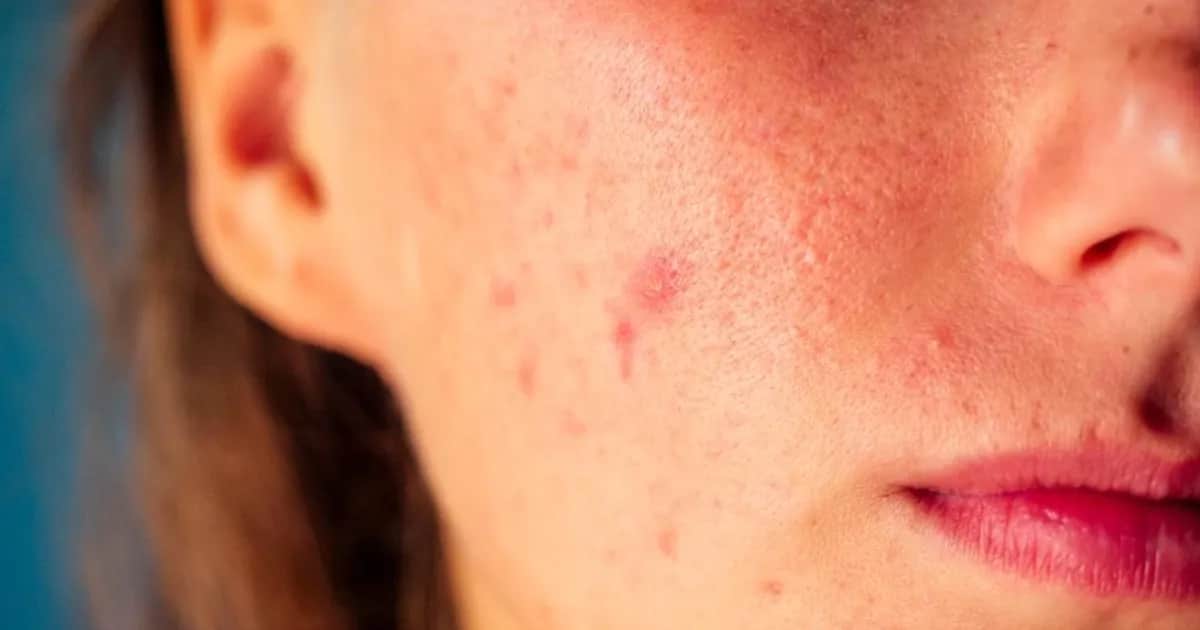 Pryszcz, który nie znika - kiedy może to być objawem choroby?