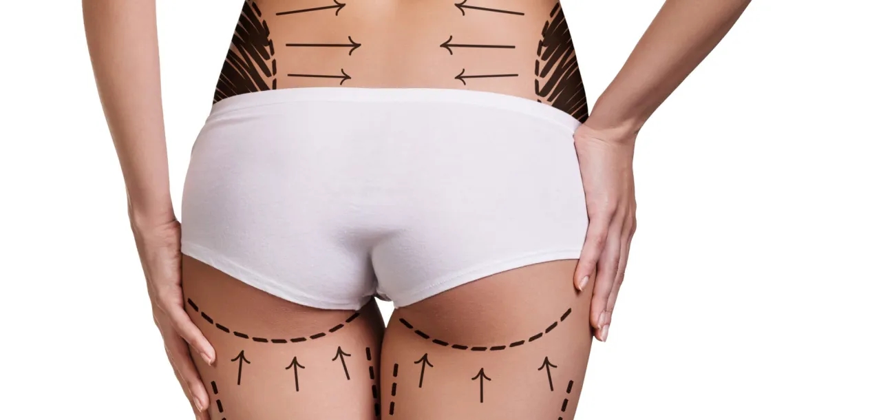 Czy po liposukcji tłuszcz wraca? Poznaj prawdę o trwałości efektów
