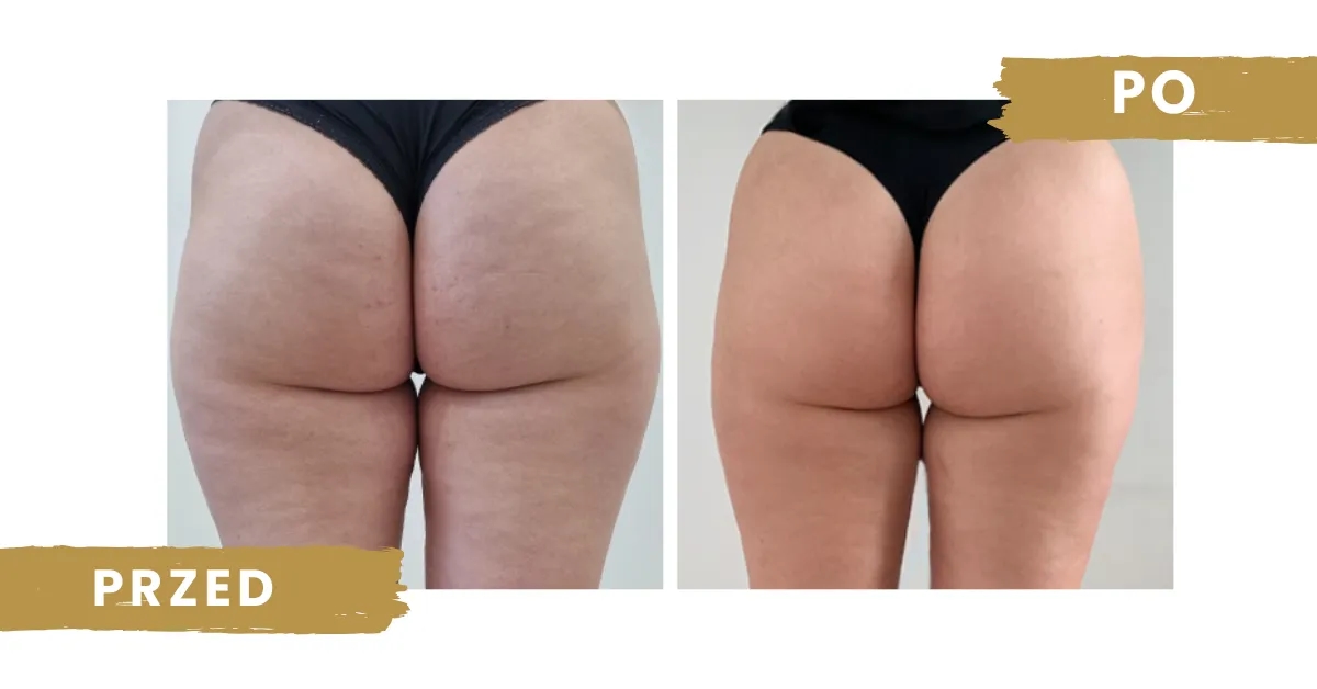 Ile zabiegów endermologii potrzebujesz, aby zobaczyć efekty?