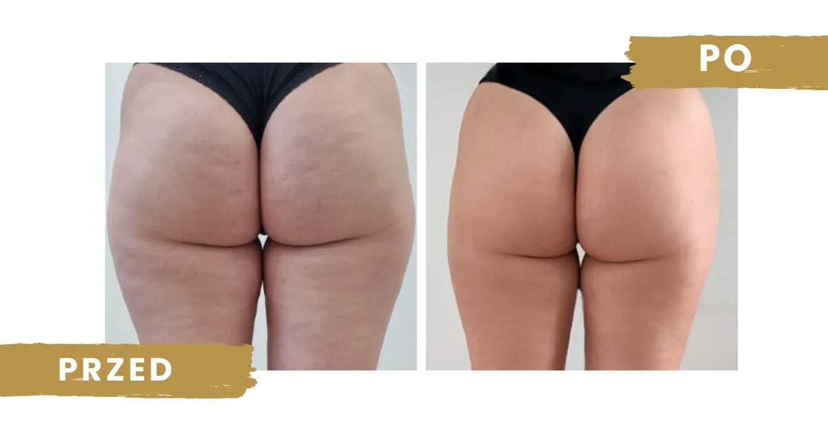 Ile zabiegów endermologii potrzebujesz, aby zobaczyć efekty?