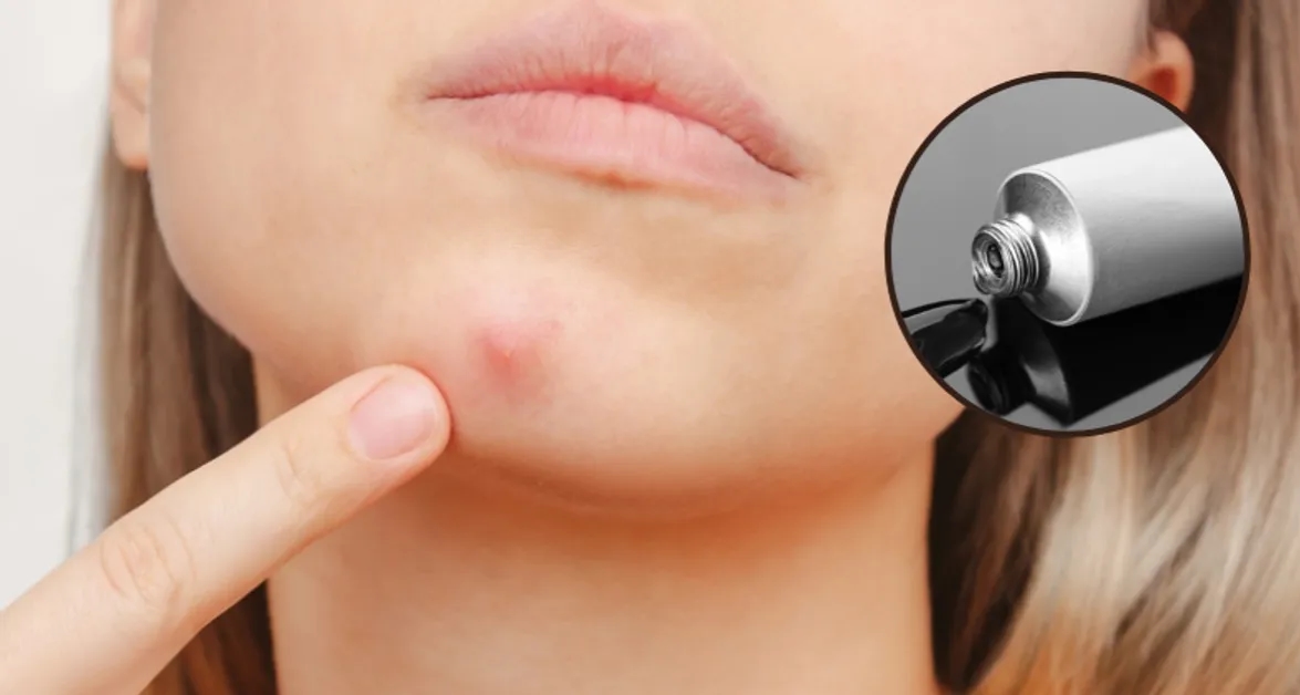 Jak pozbyć się pryszcza, który jeszcze nie wyszedł, bez wyciskania